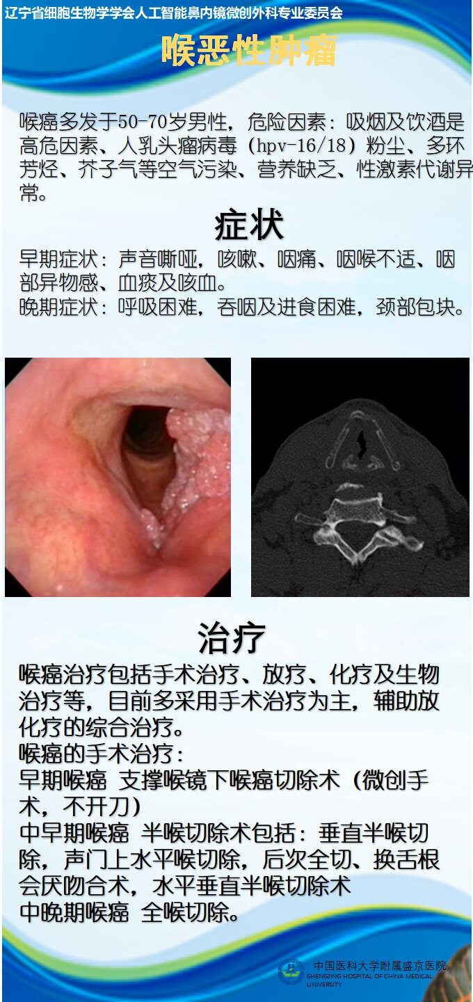 原创科普 | 喉恶性肿瘤 - 辽宁省细胞生物学学会